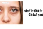 Dark Circle Kaise Hataye