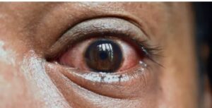 eye flu